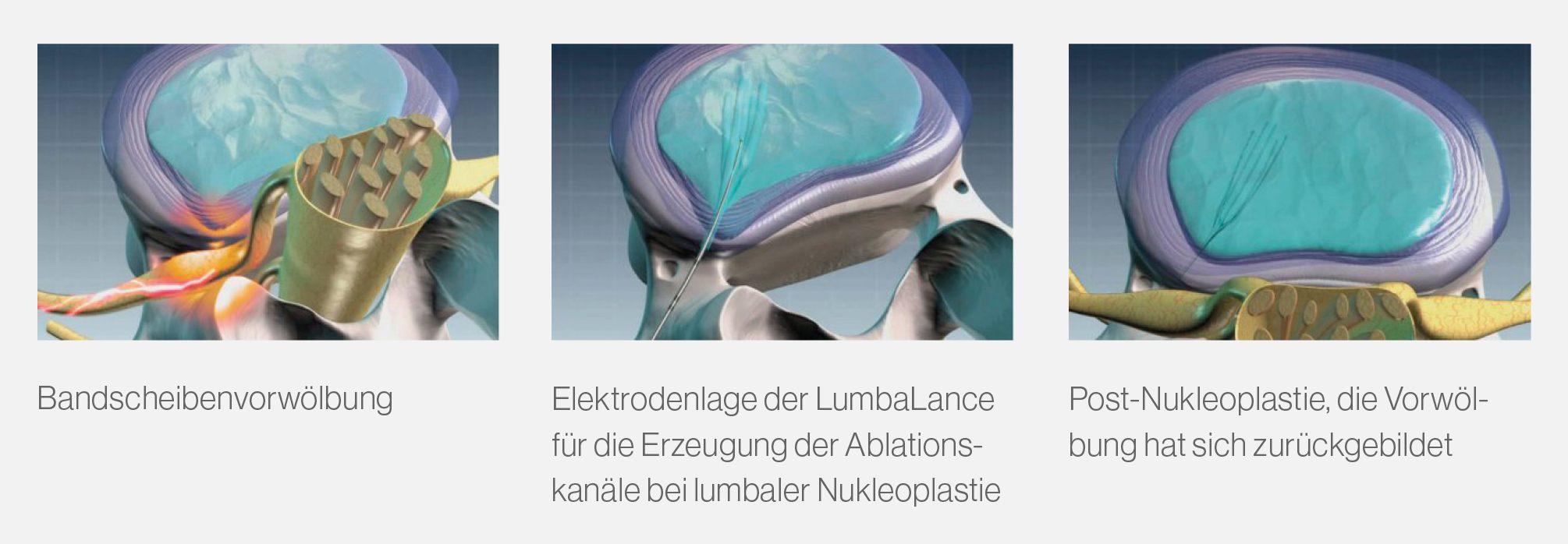Nukleoplastie